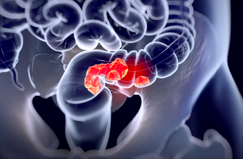 The Rise of Colon Cancer: What's Changing in Belgium, The Netherlands, Germany, France - and South Africa - and How Tech Can Help